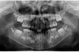 Çocuk Diş Radyografi Görüntülerinde Instance Segmentation