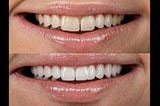 Zoom-Teeth-Whitening-1