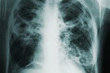 Surviving a Life-Threating Pulmonary Embolism. 3 Tips That Can Save Your Life.