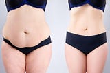 New You with Liposuction and Abdominoplasty!