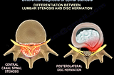 Differential Diagnosis of Spinal Stenosis