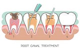 Endodontics or Root Canal Treatment in Pitampura