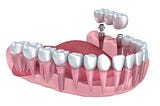 DENTAL IMPLANTS- TYPES, ARE THEY FOR LIFE