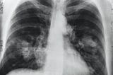 Lungs Cancer Unmasked :Identifying and Countering Risk Factors”