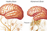 Stem Cells vs. Alzheimer’s
