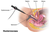 Understand Why Hysteroscopy is Done Before IVF
