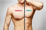 Enlarged Breast in Men — Gynecomastia