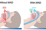 CPAP ALTERNATIVES FOR MILD-MODERATE OBSTRUCTIVE SLEEP APNEA AND SNORING