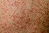 My Thoughts on the Measles Outbreak in England