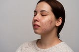 Home Remedies To Get Rid Of Acne