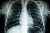 Diagnosing Pneumonia from X-Ray Images Using Convolutional Neural Network