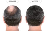 Get the Most Effective Hair Loss Treatment Near You in Warrenton, VA