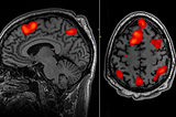 Extending the Understanding of Schizophrenia with AI