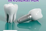 Enhance Your Smile with Premium Dental Implants in Kundrathur