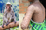 Monkeypox: What You Need to Know