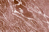 What is sickle cell disease?
