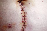 Hiding Scars or Revealing Wounds?