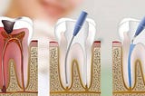 We use different expressions to indicate the same dental procedure: Root canal, root canal…