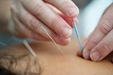 an acupuncturist placing the second needle