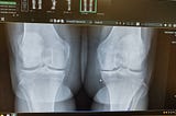 Knee Replacement Surgery, Part 1