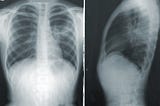 Pneumonia Detection completed by a CNN