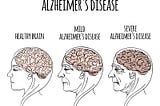 Alzheimer’s Disease: The Stages of the Disease