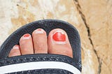 How Long Does It Take to Grow Out Runner’s Toenails? Two Years