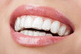 Niềng răng Invisalign là gì và những điều bạn cần biết