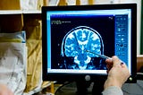 The Brain Technology Treating Neurological Disorders That Will Benefit From AI