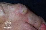 5 Surprising Facts About Callus You Didn’t Know