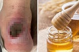 A rotting foot that couldn’t be treated with antibiotics… I applied honey to this disgusting thing…