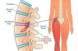 Understanding Sciatica: Causes, Symptoms, and Effective Treatments