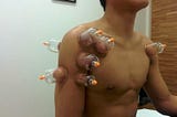 Cupping Therapy In Delhi, Procedure, Pros, and Cons