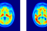 Breakthrough: Brain-Amyloid Imaging via EEG