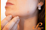 Get Best Acne Scars Treatments in Delhi