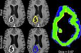 Image Segmentation — Multimodal Brain Tumor Semantic Segmentation Using 3D U-Net Architecture