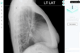 The automated segmentation of a lung in a lateral thoracic x-ray