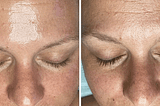 Tribella Treatment Portland