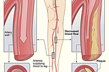 Peripheral artery disease