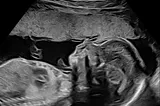 Fetal ultrasound