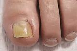 Discover the solution that permanently kills Toenail fungus At Home