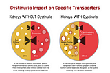 Cystine Kidney Stones- The Nastiest of All