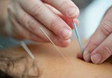 Acupuncture Treatment For Pain