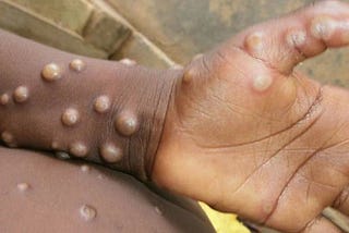 How monkeypox takes the world’s breath away in 2022…