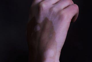Vitiligo Is A Universal Headache For Medical Science