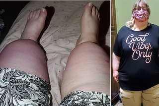 Doctors Told Me I Was ‘Just Fat’ — My Serious Medical Condition Was Missed