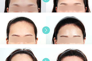 Everything You Need to Know About Forehead Reduction Surgery