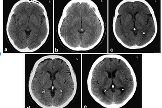 Mineral Neurotoxin Warning