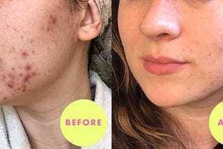 Remove Pimples Overnight | Acne Treatment
