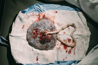 a fresh placenta right after delivery